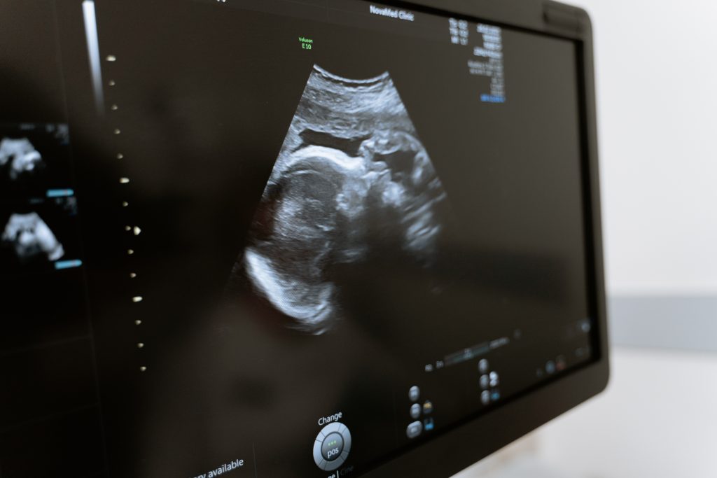 Ultrasound of baby, maybe conceived using egg freezing!